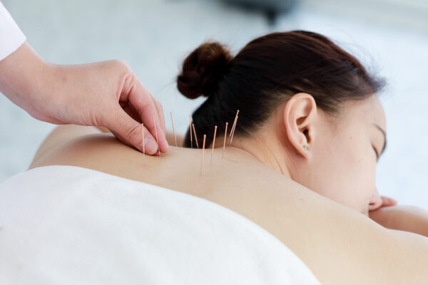 a woman undergoing acupuncture treatment