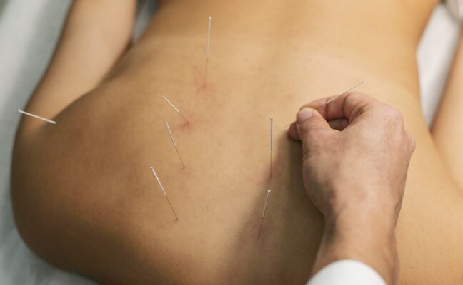 image of a man's back that has acupuncture needles stuck on them 