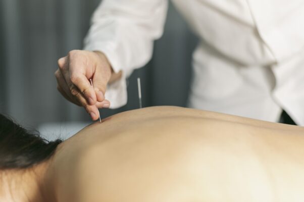 image of a chinese man getting acupuncture needles put on his back by a doctor 